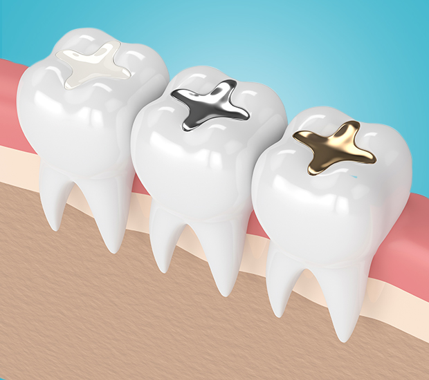 Rosenberg Composite Fillings