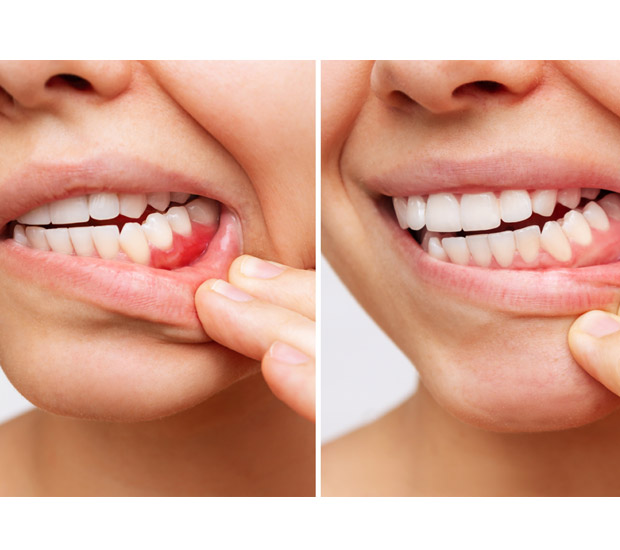Rosenberg Gum Disease