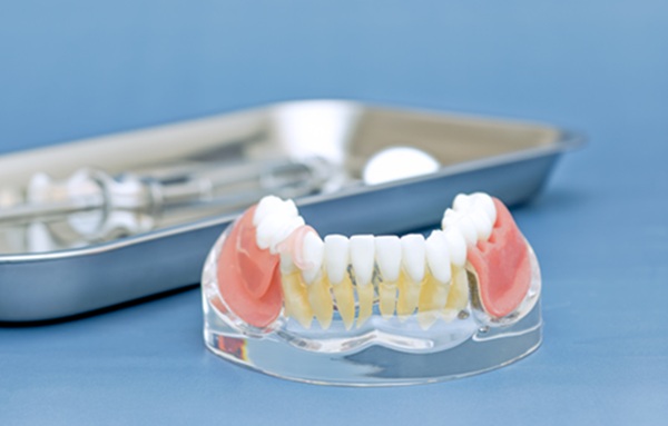 Learning Which Tooth Replacement Option To Choose: Implants, Bridges, Or Dentures?