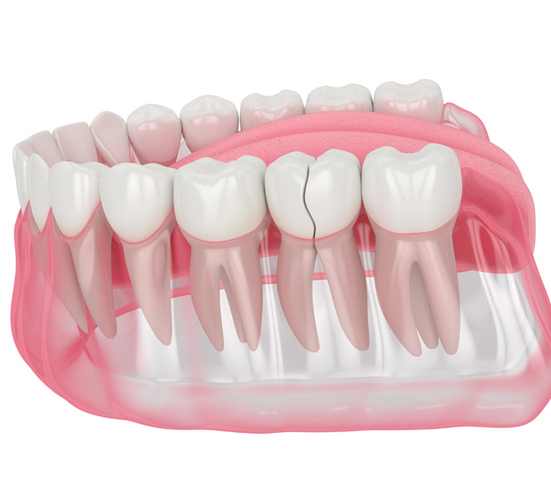 Rosenberg Types of Dental Root Fractures